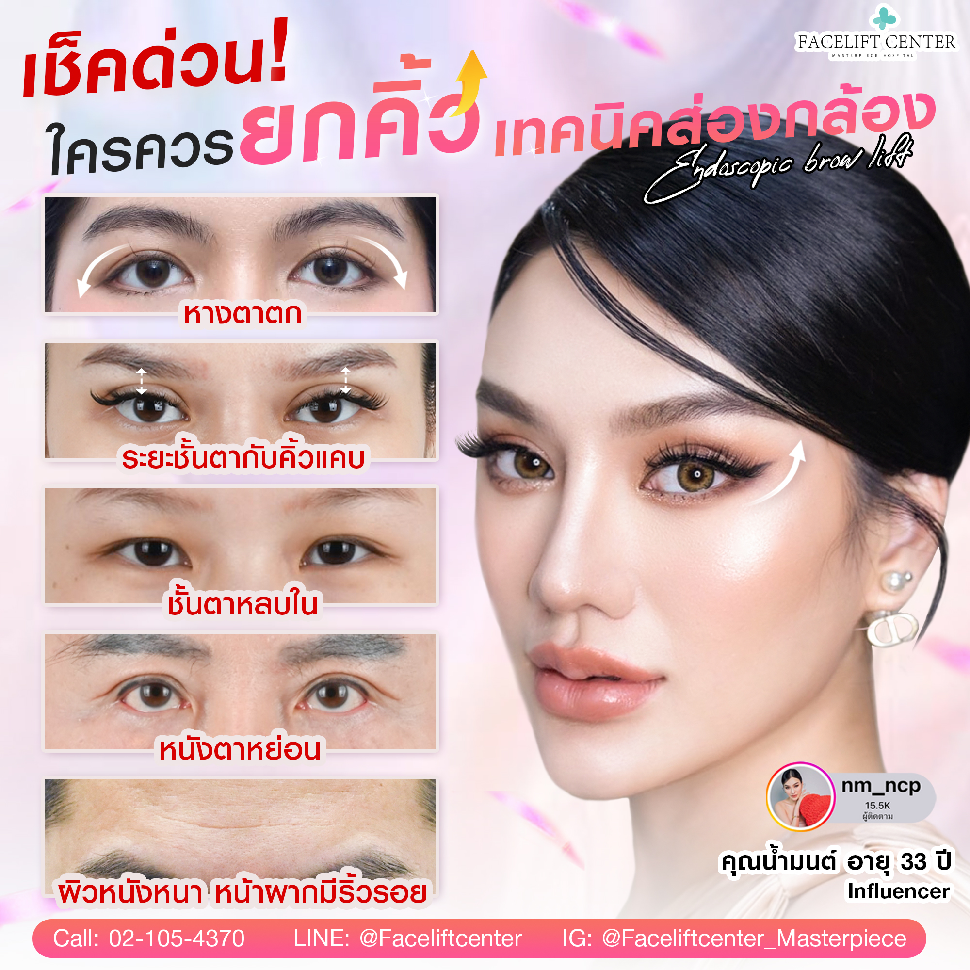 Endotine-ยกคิ้วส่องหล้อง