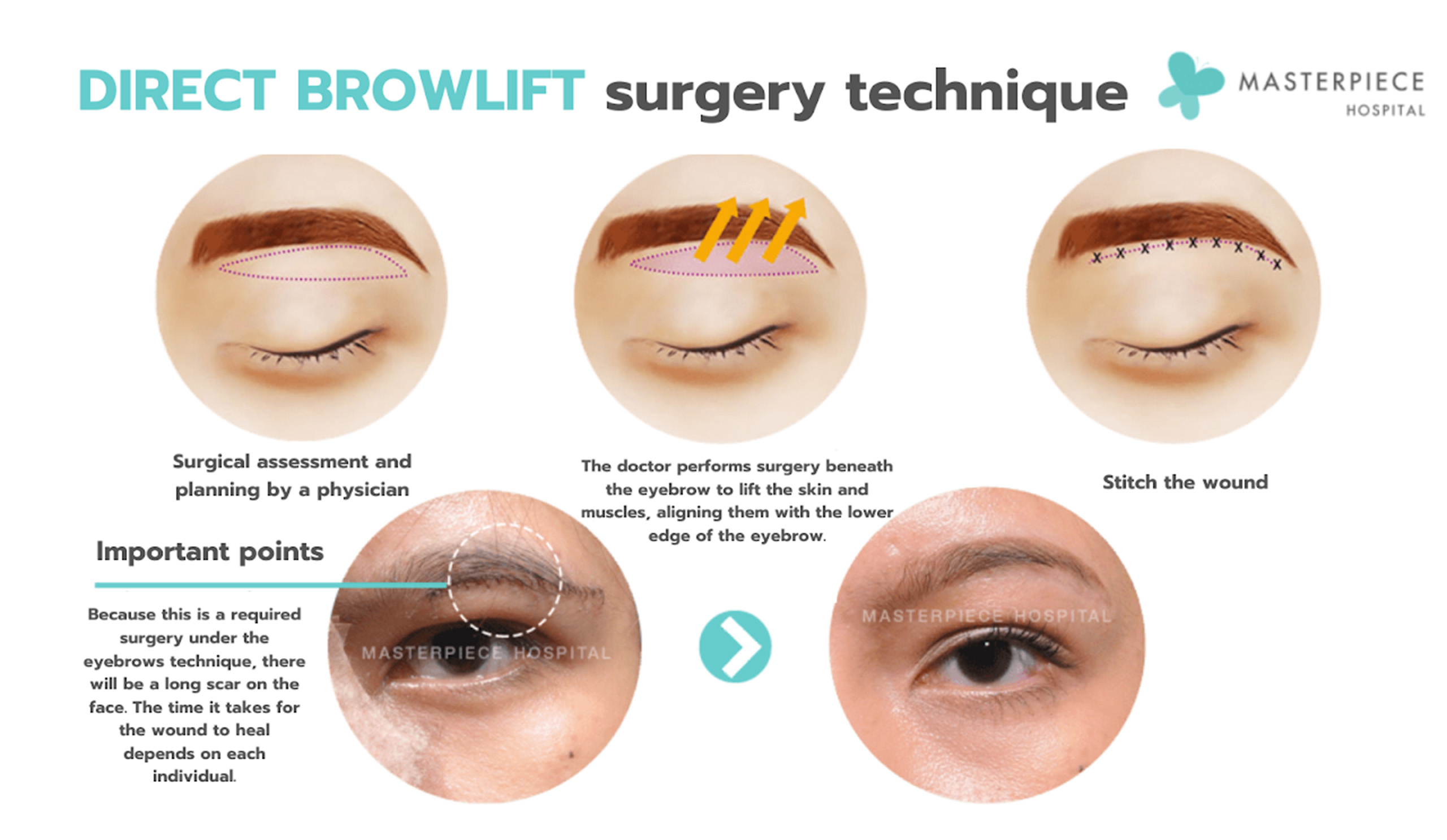 FaceliftandBrowlift3