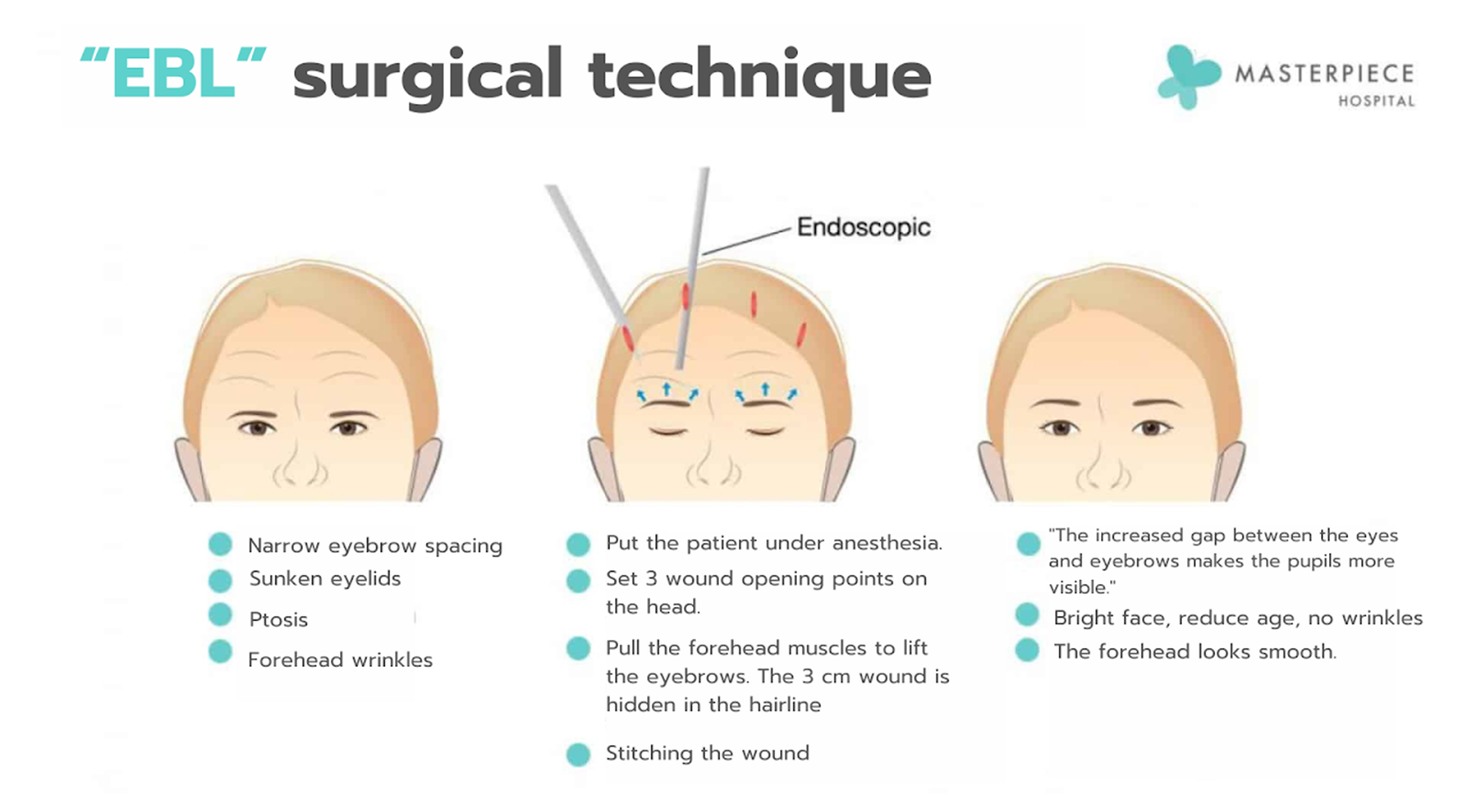 FaceliftandBrowlift5