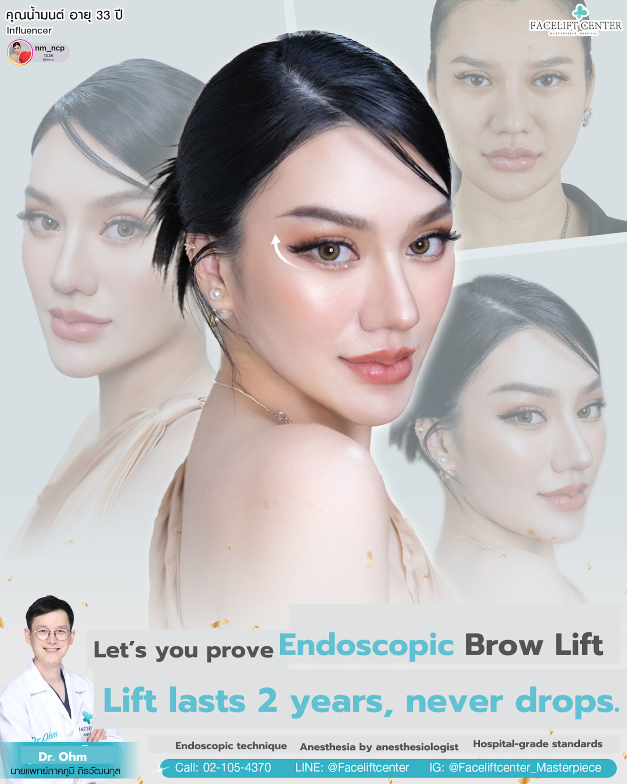 FaceliftandBrowlift9