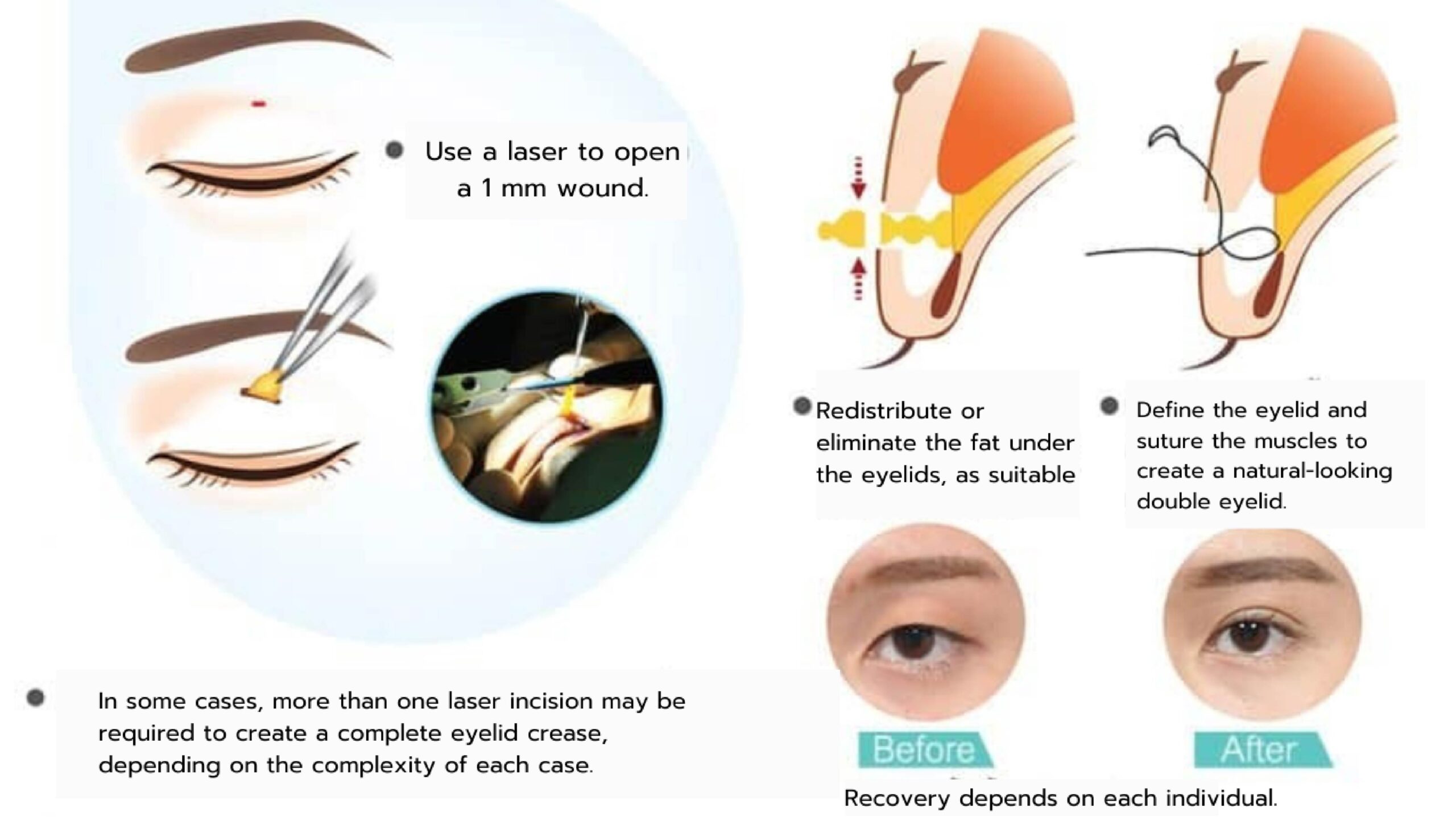 doubleeyelids9 ver Eng-01