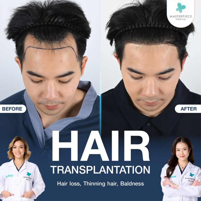 Hair transplantation treats thinning hair and permanently brings hair back to thickness.