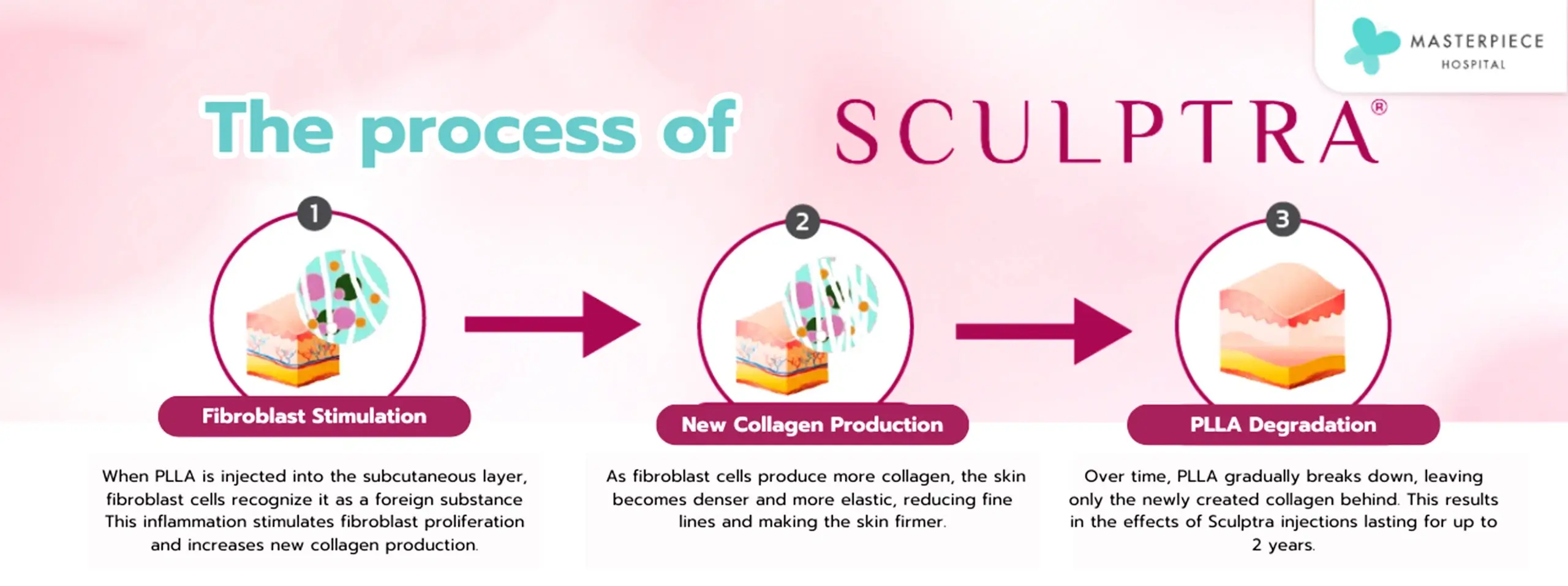 The process of Sculptra