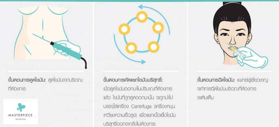 การดูไขมันในร่างกายมาเติมในส่วนอื่นเห็นผลดีและปลอดภัย