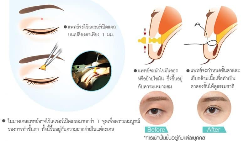 ขั้นตอนการทำตาสองชั้น Celebrity eye