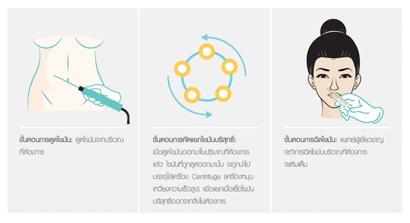 จำลองวิธีการศัลยกรรมเติมเต็มด้วยเซลล์ไขมันตัวเอง ขั้นตอนแรกจะดูดไขมันจากส่วนที่ต้องการ ขั้นที่สองนำไขมันไปเข้าเครื่อง Centrifuge เพื่อนำมาใช้ในการฉีดเติมเข้าร่างกาย ขั้นสุดท้ายฉีดไขมันเติมตามจุดต่าง ๆ 