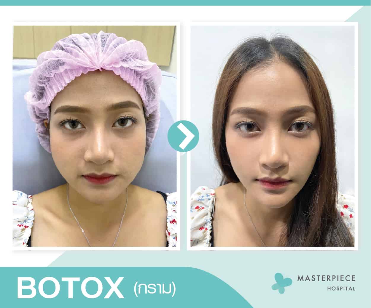 Botox โบท็อกซ์กรามหน้าเรียวเล็ก สวยได้รูป