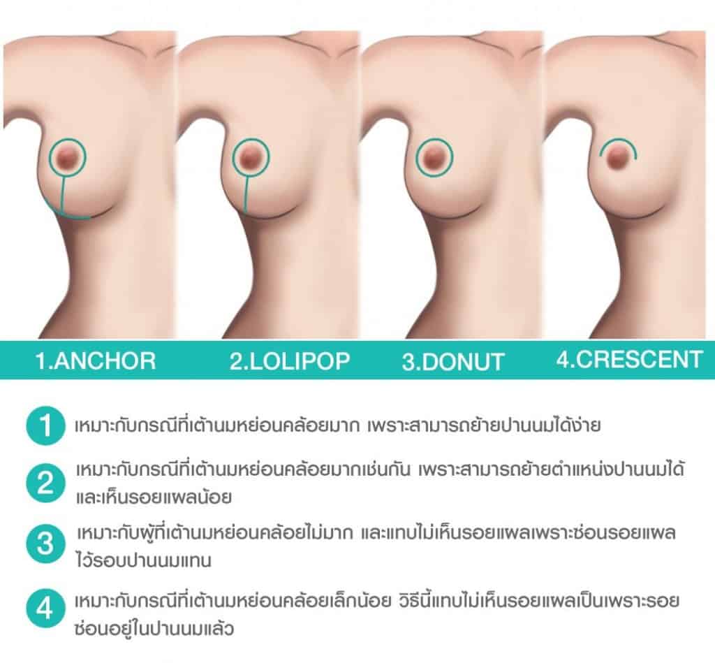 เทคนิคการผ่าตัด ยกกระชับทรวงอก สามารถย้ายปานนมทำให้ดูกระมาขึ้นได้ด้วย