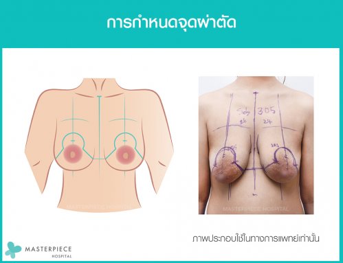 ก่อนผ้าตัดจะมีการกำหนดจุดผ่าตัด ยกกระชับนม ก่อนเพื่อวางแผนการผ่าตัดให้ประสบผลสำเร็จที่สุด