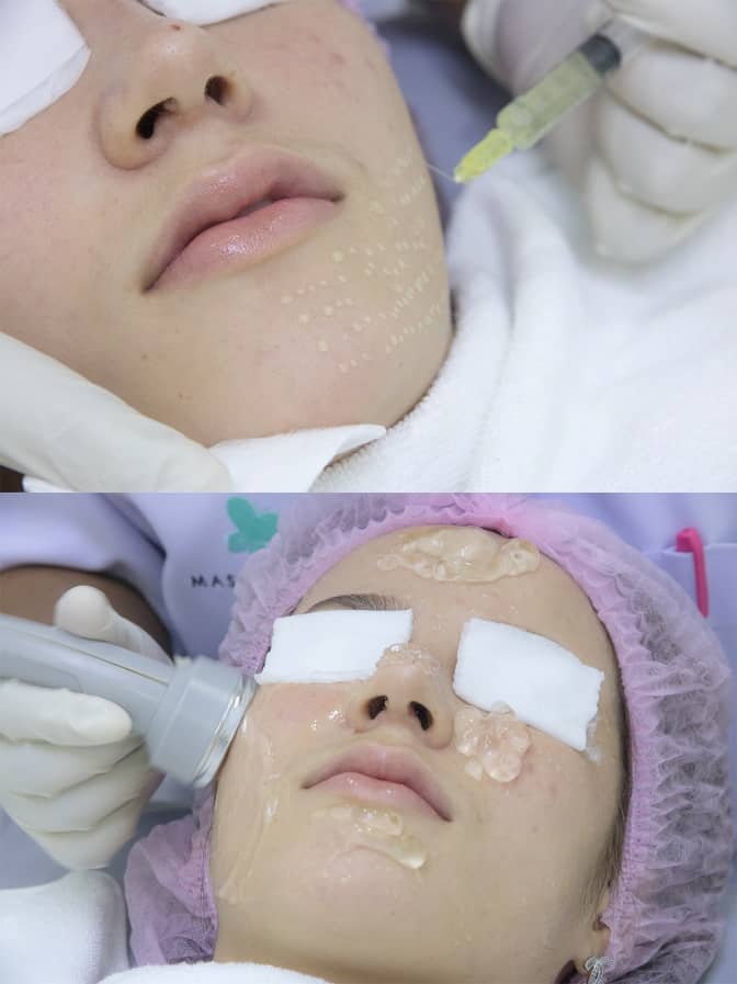 การทำ Meso ต่อด้วยการทำบำรุงผิวหน้า Face lifing Massage