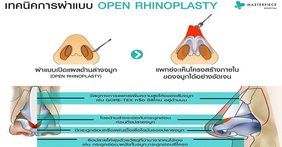 จำลองการเสริมจมูกแบบเปิด (Open)