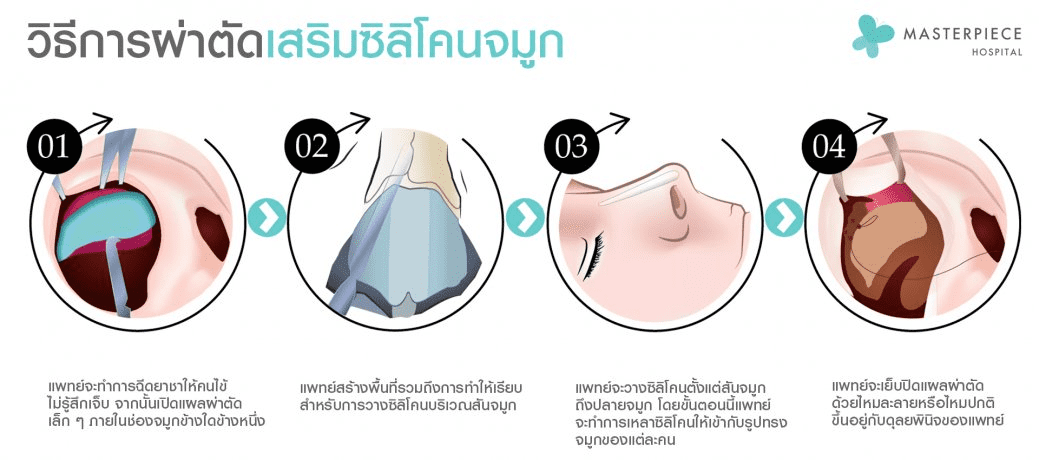 จำลองการผ่าตัดเสริมจมูกซิลิโคน