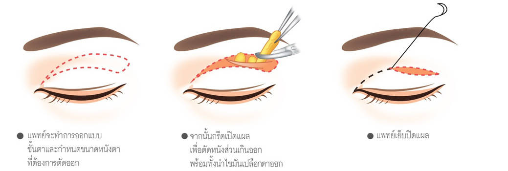 ขั้นตอนกการทำ FULL INCISION DOUBLE EYES ศัลยกรรมตาสองชั้นเทคนิคเปิดแผลยาว