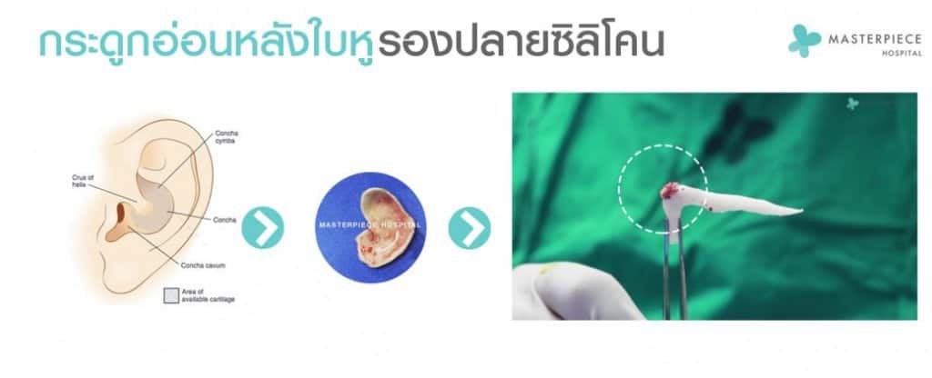 นำกระดูกอ่อนหลังหูมารองปลายซิลิโคนจมูก มาใช้ในการเสริมจมูก