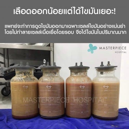 โหลใส่ไขมันจากการดูดด้วยเครื่อง VASER LIPOSUCTION ของโรงพยาบาลมาสเตอร์พีช