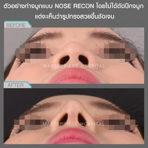 ตัวอย่างการทำจมูกแบบ NOSE RECON โดยไม่ได้ตัดปีกจมูก