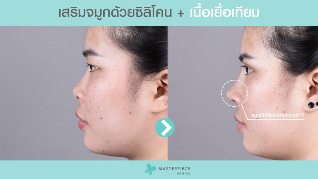 รีวิวหน้าด้านข้างก่อนและหลังเสริมจมูกด้วยซิลิโคน และเนื้อเยื่อเทียม