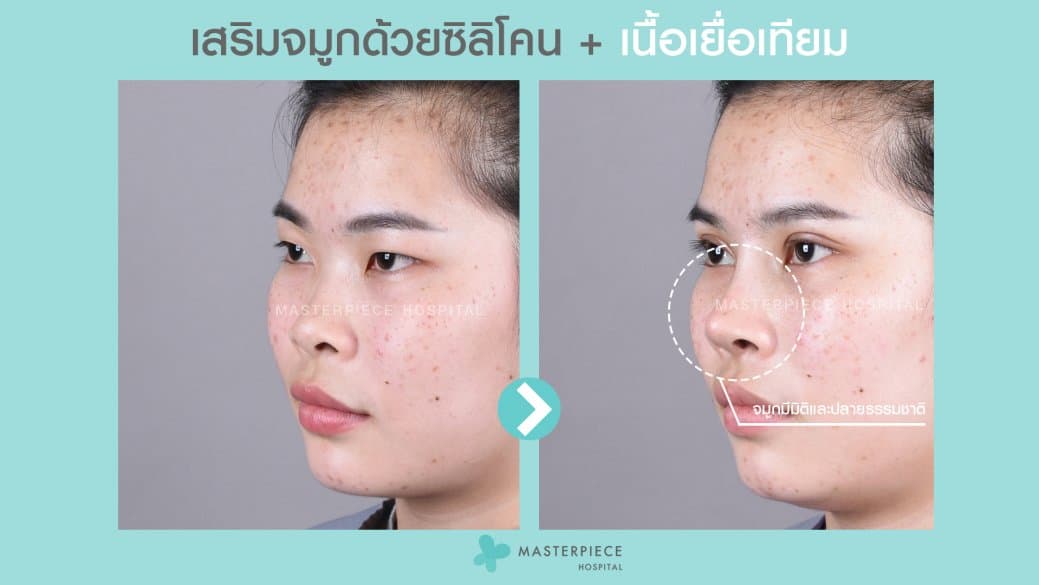 รีวิวเสริมจมูกด้วยซิลิโคนพ่วงกับเนื้อเยื่อเทียม ก่อนและหลังทำ