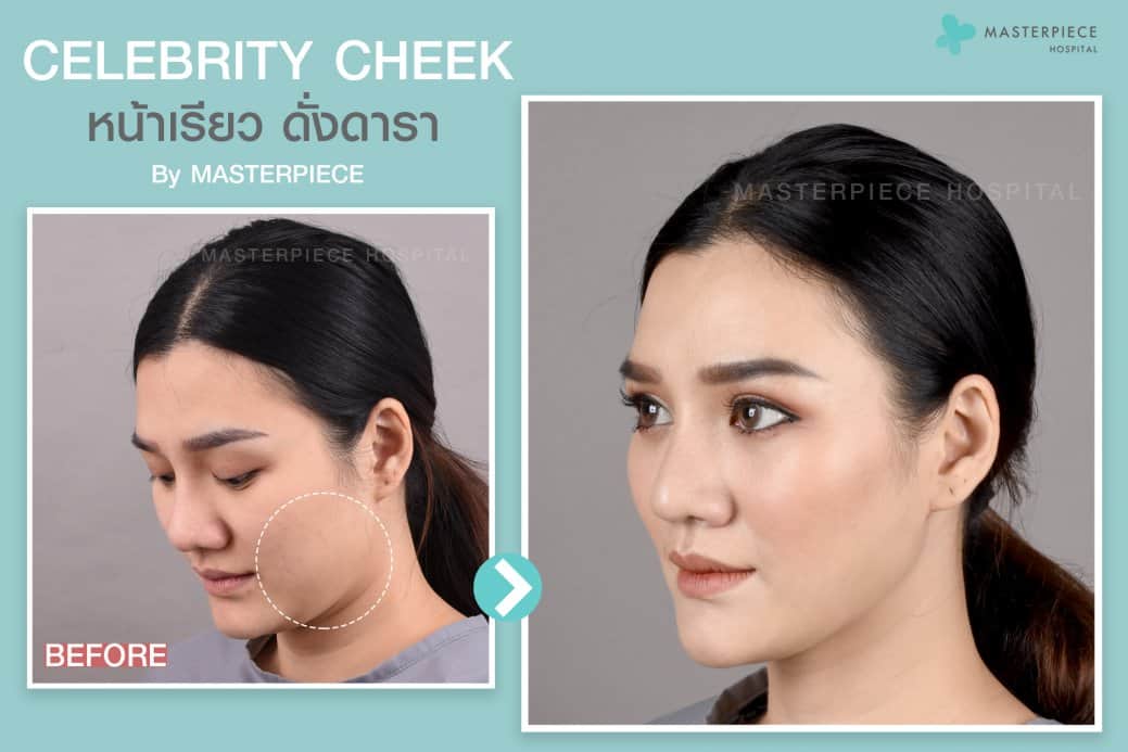 รีวิวหน้าด้านข้างก่อนและหลังตัดกระพุ้งแก้ม แก้มยุบเข้ารูปเป็น V shape 