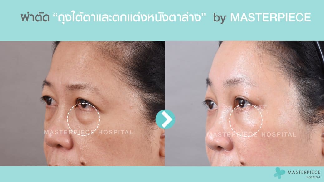 Review before & after กำจัดถุงใต้ตา ที่ทำให้อ่อนเยาว์ลงได้อย่างเห็นได้ชัด 