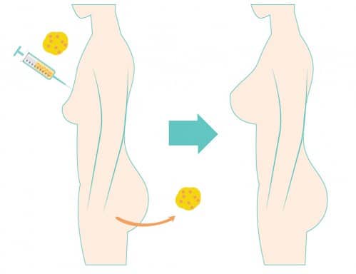 จำลองการนำไขมันมาเติมหน้าอกและสะโพก 