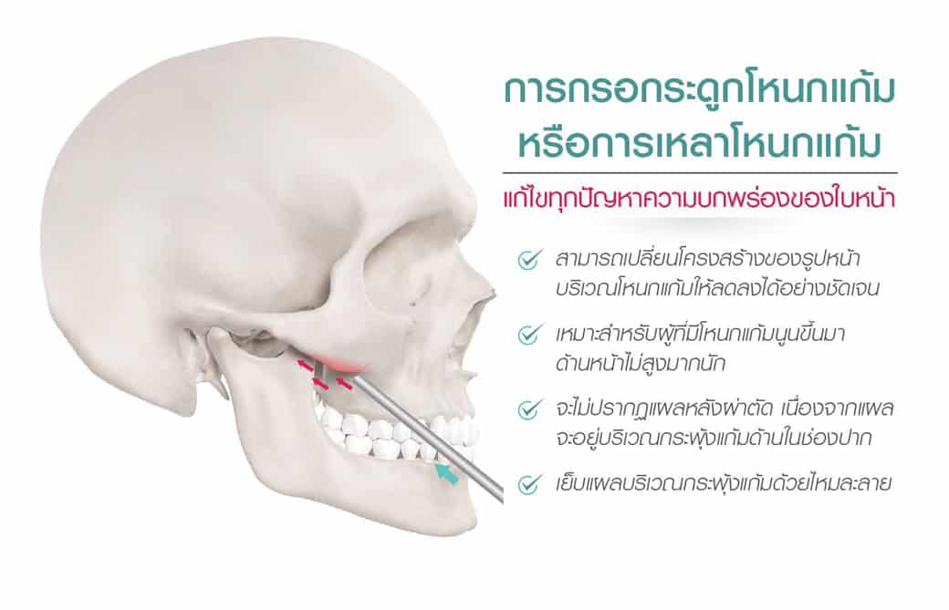 กระโหลกหันข้างแสดงการใช้เครื่องมือกรอโหนกแก้มด้านล่าง สำหรับแก้ไขปัญหาบนใบหน้า