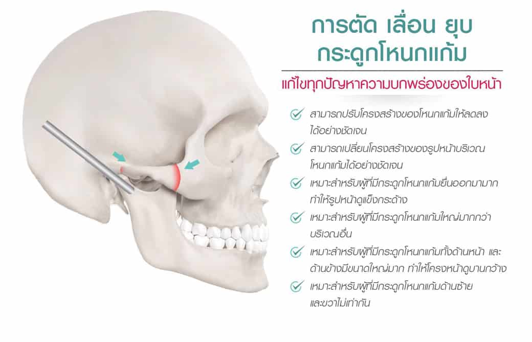 กระโหลกแสงภาพตำแน่งกรอโหนกแก้มด้านข้าง เพื่อปรับโครงสร้างหน้า