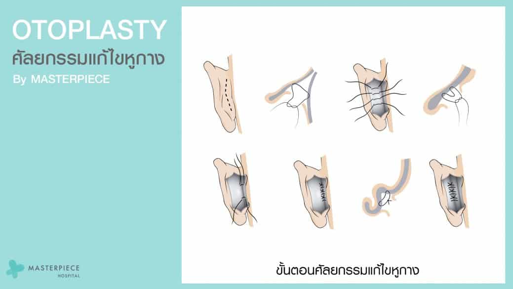 ขั้นตอนการผ่าตัดศัลยกรรมแก้ไขหูกาง โดยเริ่มจากการผ่าเปิดหลังหู ตัดกระดูกอ่อน และเย็บปิดแผล