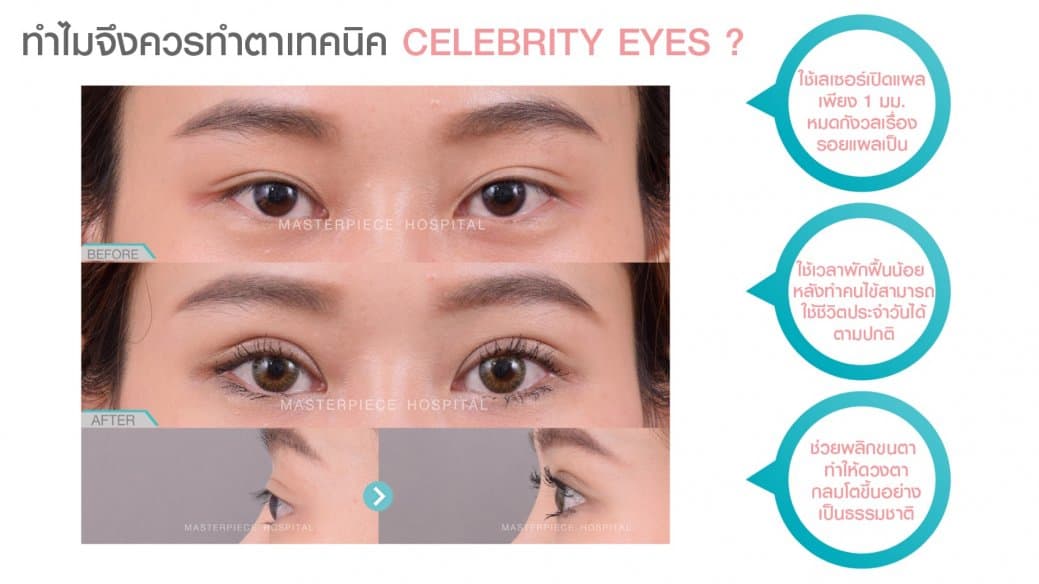 ข้อดีของการทำ Celebrity eyes คือหายไว ตาสวยอย่างเป็นธรรมชาติ