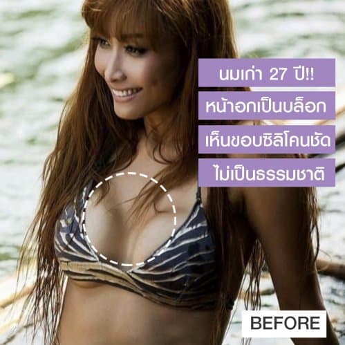 รีวิว แก้ไขหน้าอกหน้าก่อนหน้าเป็นรูปซิลิโคนให้สวยเนียนเป็นธรรมชาติ