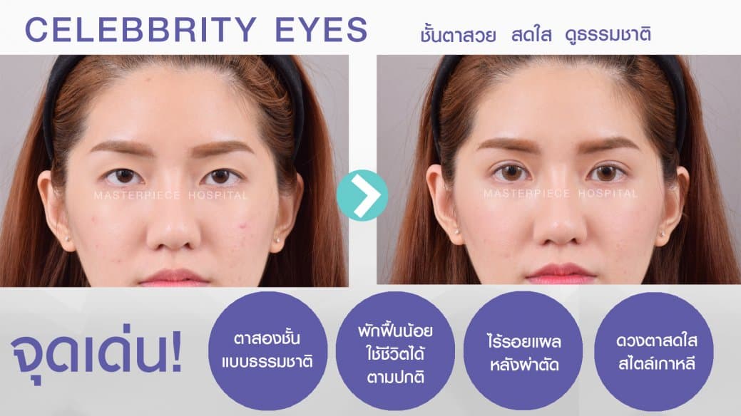 รีวิวจุดเด่นของการทำตาด้วยเทคนิค CELEBRITY EYES ไม่ต้องพักฟื้นนาน ทำงานได้ปกติ