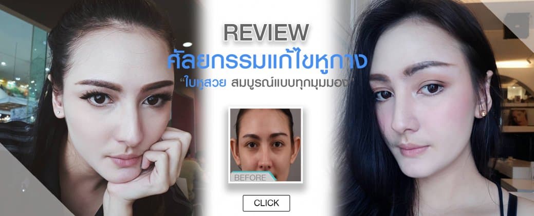 รีวิวเปรียบเทียบก่อนและหลังศัลยกรรมแก้ไขหูกาง Otoplasty จะเห็นความแตกต่างอย่างเห็นได้ชัด