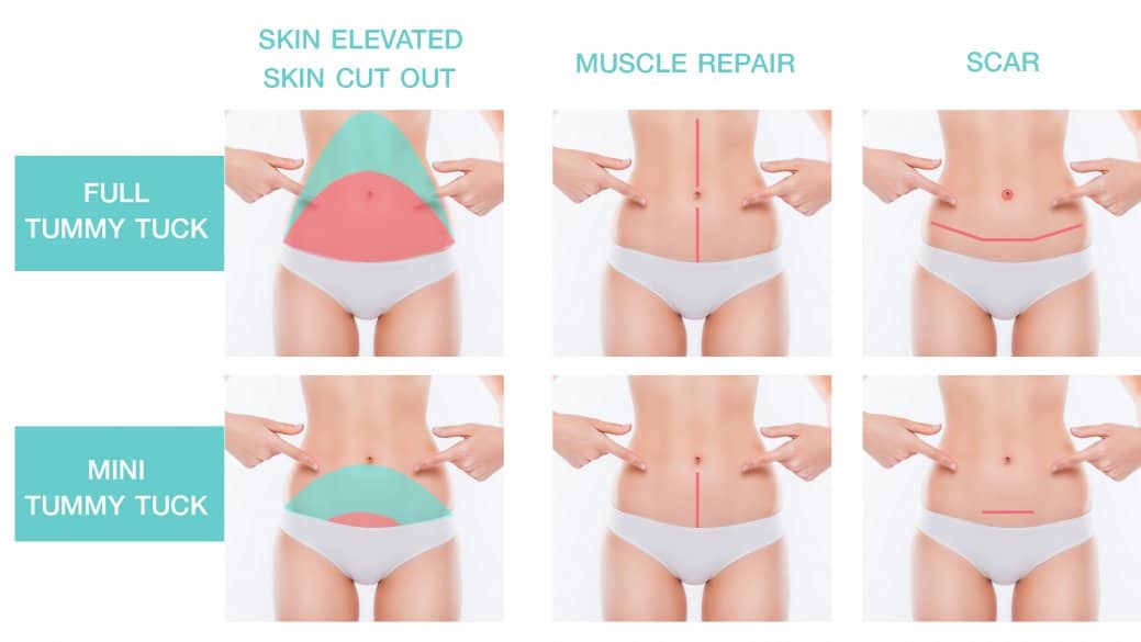 รูปแบบเทคนิคการผ่าตัด ตัดหนังหน้าท้อง ทั้งแบบ full และ mini Tummy Tuck 