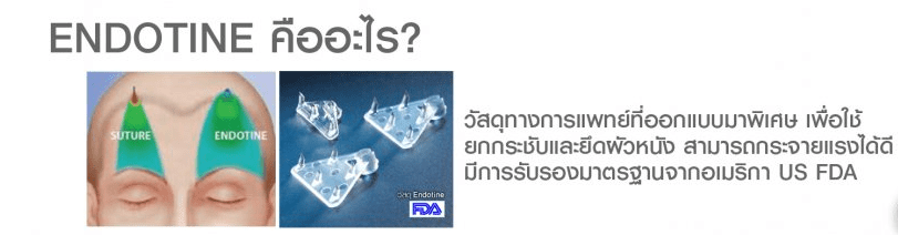 Endotine คือวัสดุทางการแพทย์เพื่อใช้ยกกระชับและยึดผิวหนัง