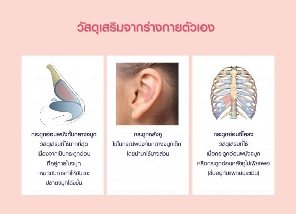 วัสดุที่ใช่เสริมจมูกโอเพ่นมีกระดูกอ่อนผนังกั้นกลางจมูก กระดูกหลังหู กระดูกอ่อนซี่โครง