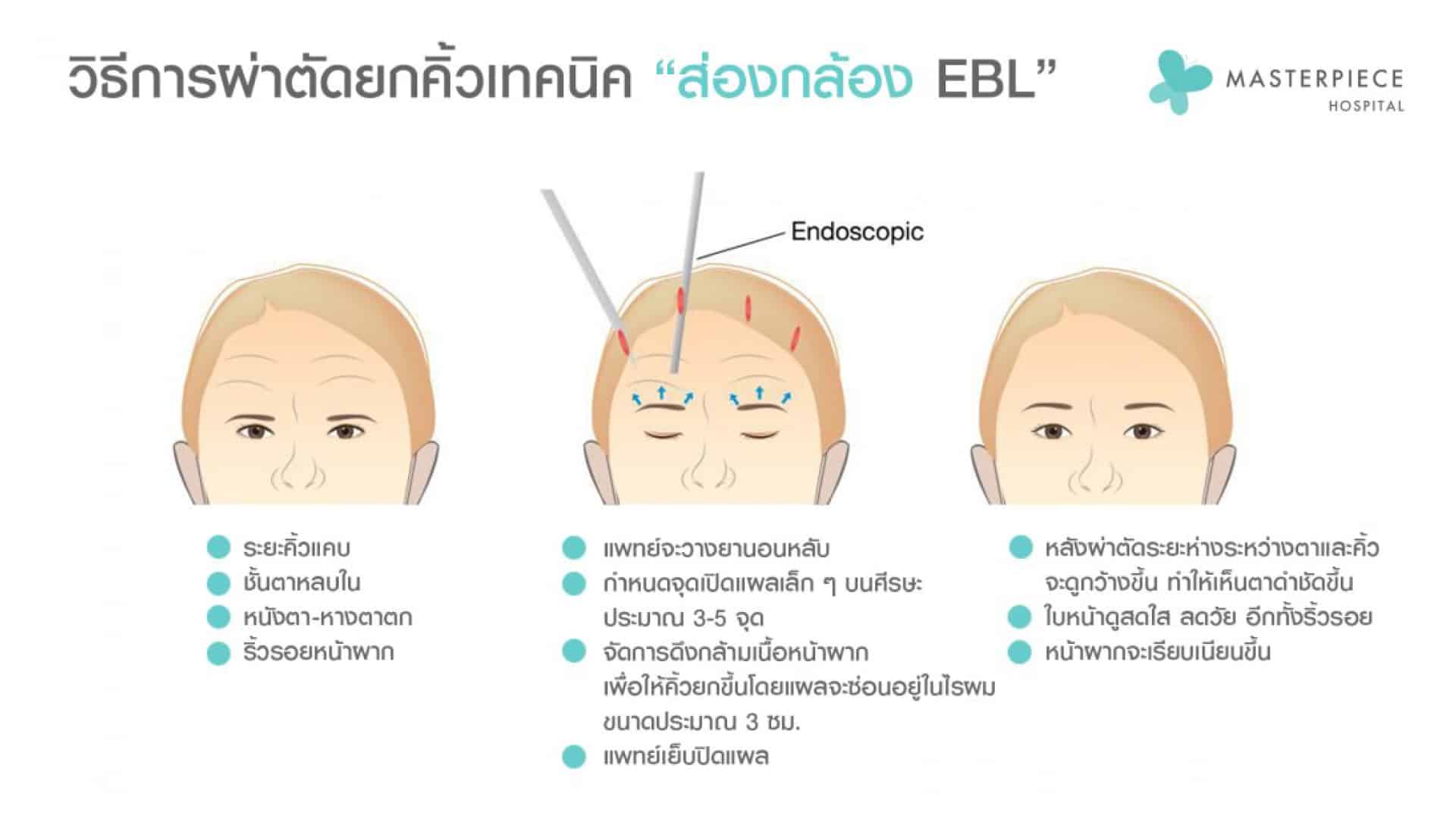 วิธีการผ่าตัดยกคิ้วเทคนิค ส่องกล้อง ebl  