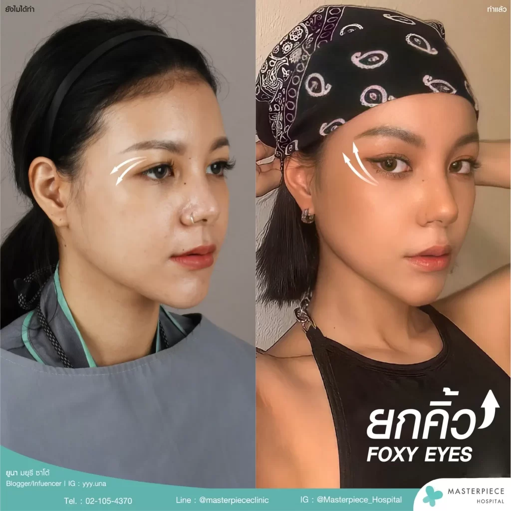 FOXY EYES คือศัลยกรรมยกคิ้วที่ทำให้หางตัวดูโฉบเฉี่ยว ยกหางตาให้ดูมั่นใจหางตาไม่ตกีอกต่อไป