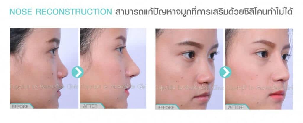 รีวิวแก้จมูกแบบโอเพ่นโดยรวมทั้งหมดไม่เฉพาะแค่ความโด่ง ! จมูกโด่งเด่นอย่างเห็นได้ชัด