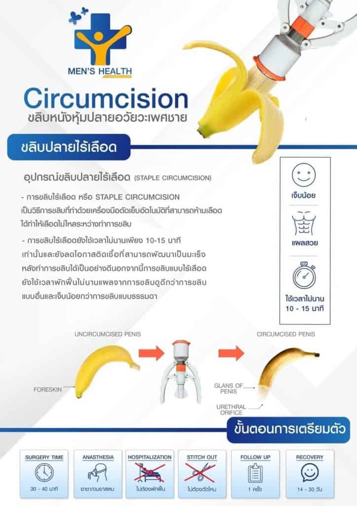 การขลิบไร้เลือดด้วยอุปกรณ์คลิปไร้เลือด ที่ดำเนินการด้วยแพทย์ผู้เชี่ยวชาญ