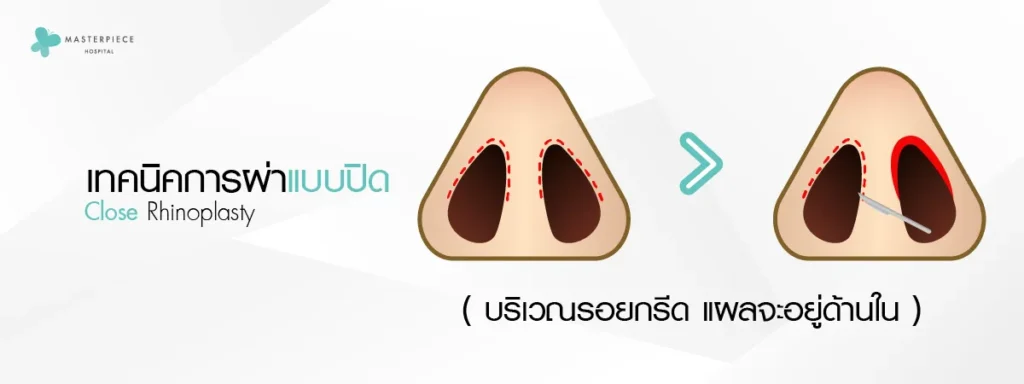 จำลองการผ้าจมูกแบบปิดมีแผลแบบไม่เห็นกระดูกจมูกเป็นแผลด้านในจมูก