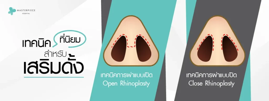 จำลองจมูกด้านหน้า มีรอยประแทนการผ่าตัดจมูกแบบ Open และ แบบ Close