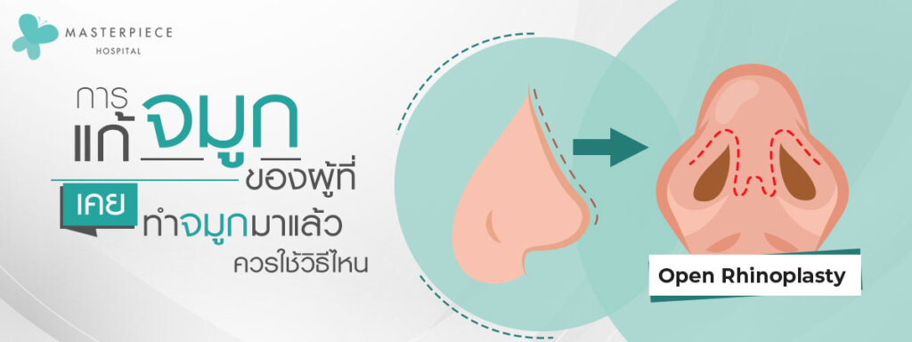 การแก้จมูกของผู้ที่เคยทำจมูกมาแล้วควรใช้โอเพ่น