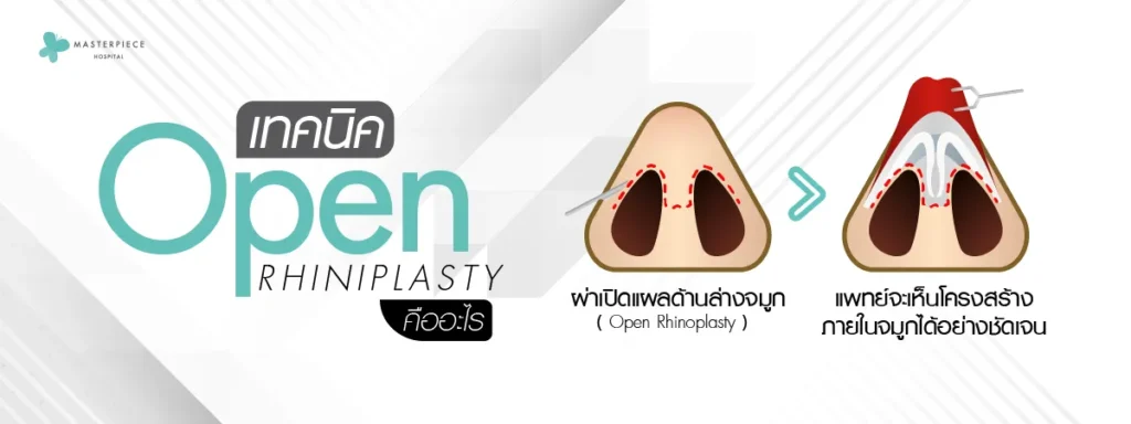 จำลองการผ่าตัดจมูกเทคนิค Open