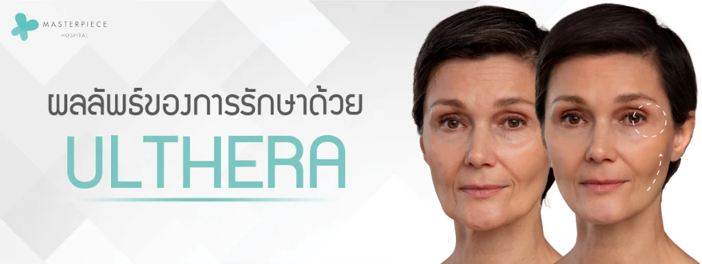 ผลลัพธ์ของการรักษาด้วย ULTHERA