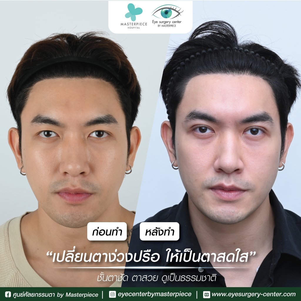 รีวิว ตาสองชั้น ผ่าตัดถุงใต้ตาแก้รูปตาให้ดูอ่อนวัยและสดชื่น