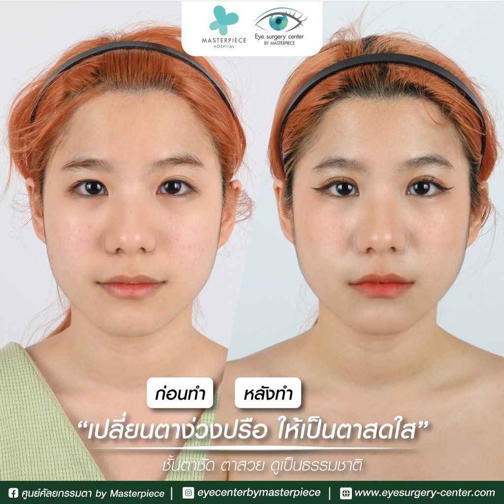 รีวิว ตาสองชั้น ผ่าตัดถุงใต้ตาลดถุงใต้ตา ทำให้ดูหน้าใส่อ่อนวัย