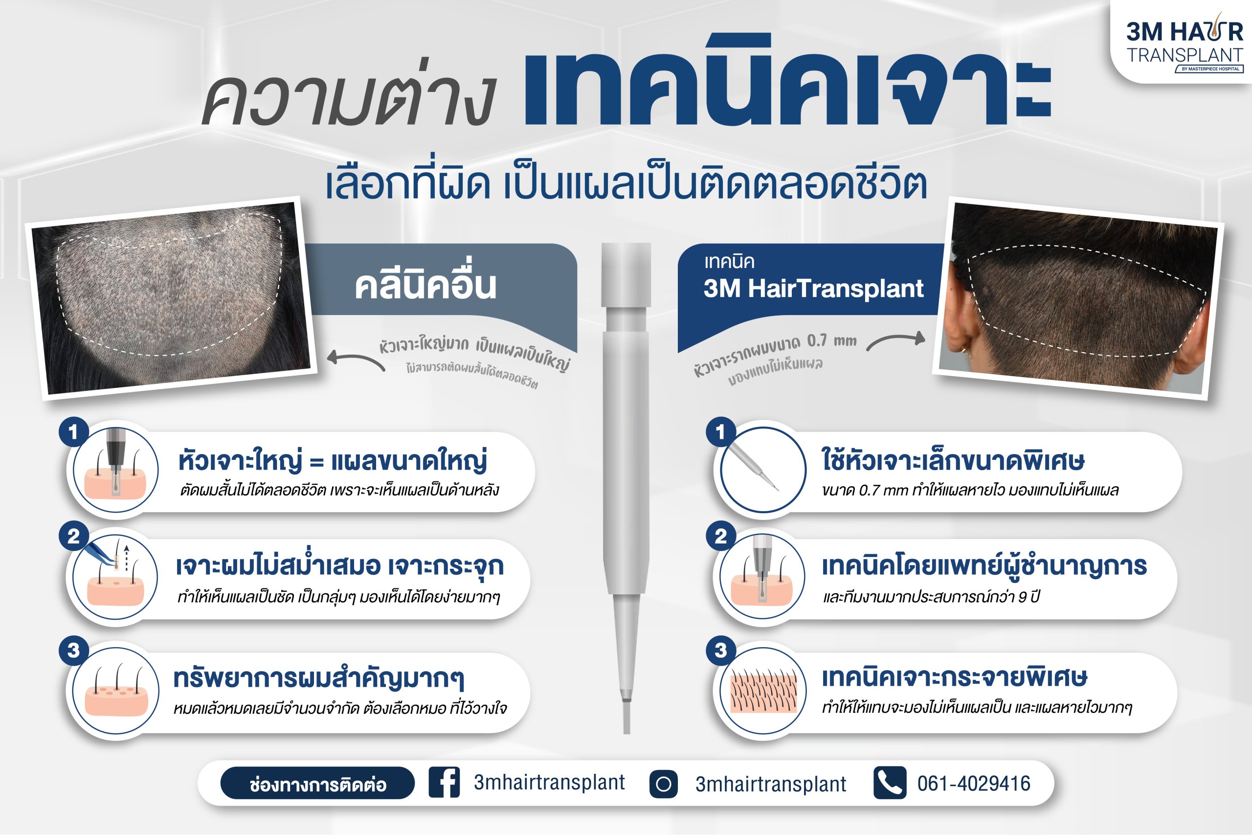 เทคนิคการปลูกผมที่มีเฉพาะที่โรงพยาบาลมาสเตอรืพีช เพื่อให้ได้ผลลัพการปลูกผมที่ดีที่สุด