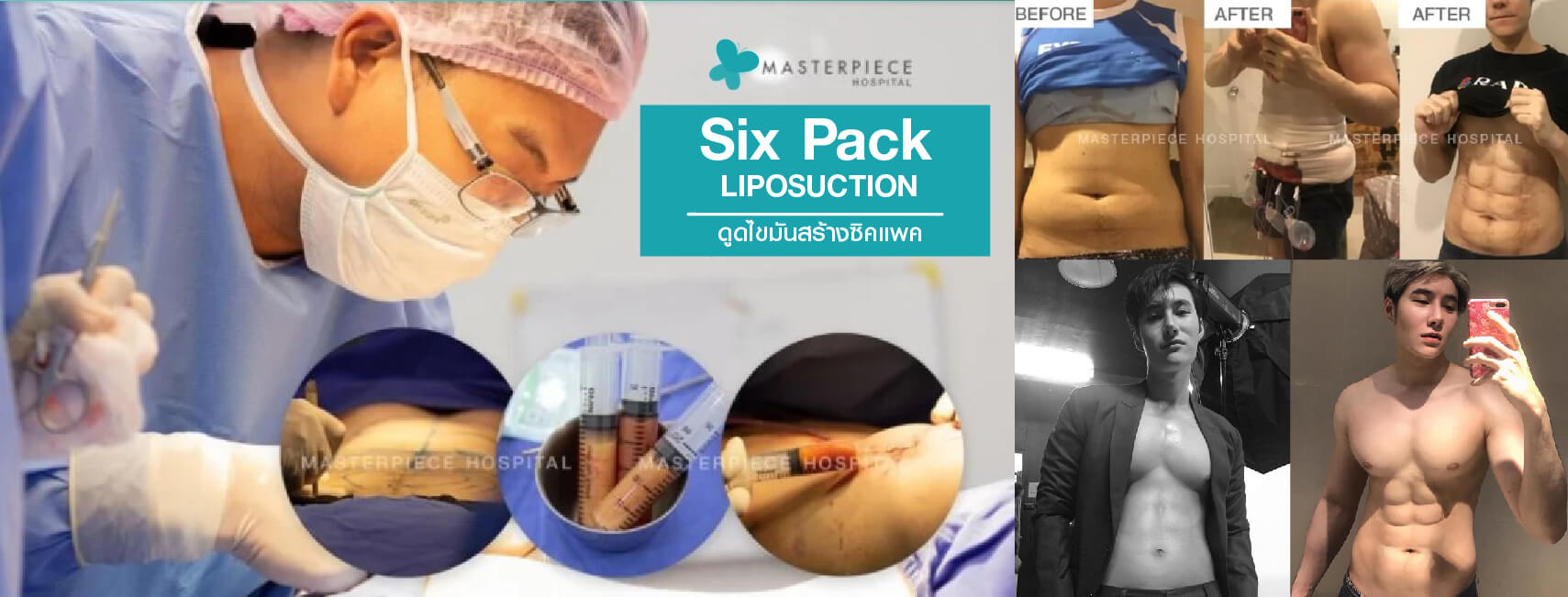 รีวิว six pack liposuction และและผลลัพธ์หลังทำการดูดไขมัน