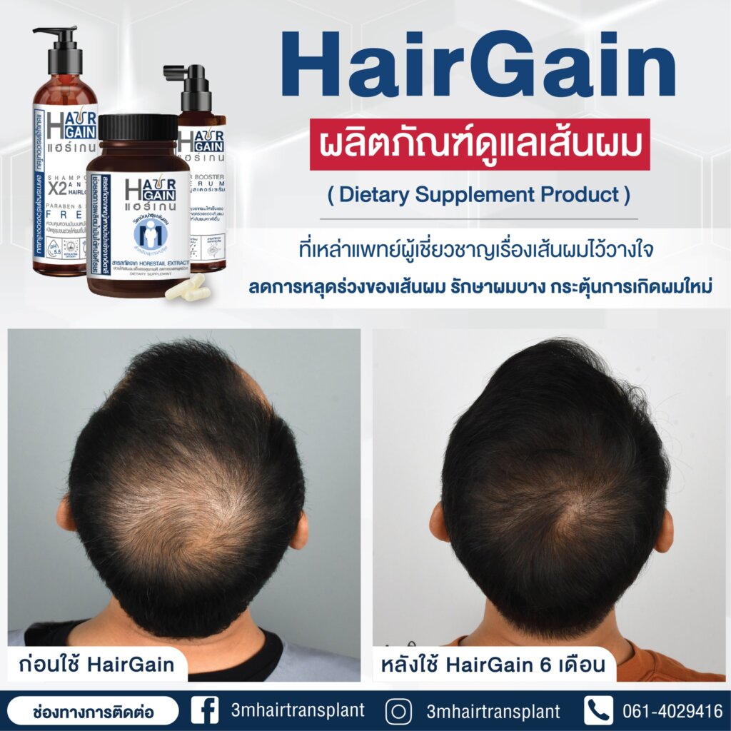 รีวิว HairGain ผลิตภัณฑ์ดูแลเส้นผมหลังจากใช้ต่อเนื่อง 6 เดือน ผมหนาแน่นขึ้นอย่างเห็นได้ชัด