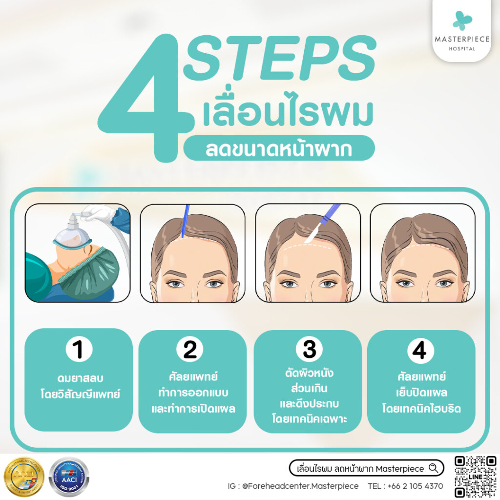 4 ขั้นตอนการลดหน้าผากเลื่อนไรผม